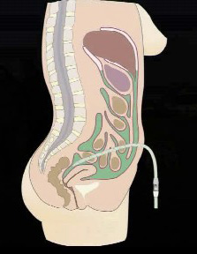 Peritonealdialys